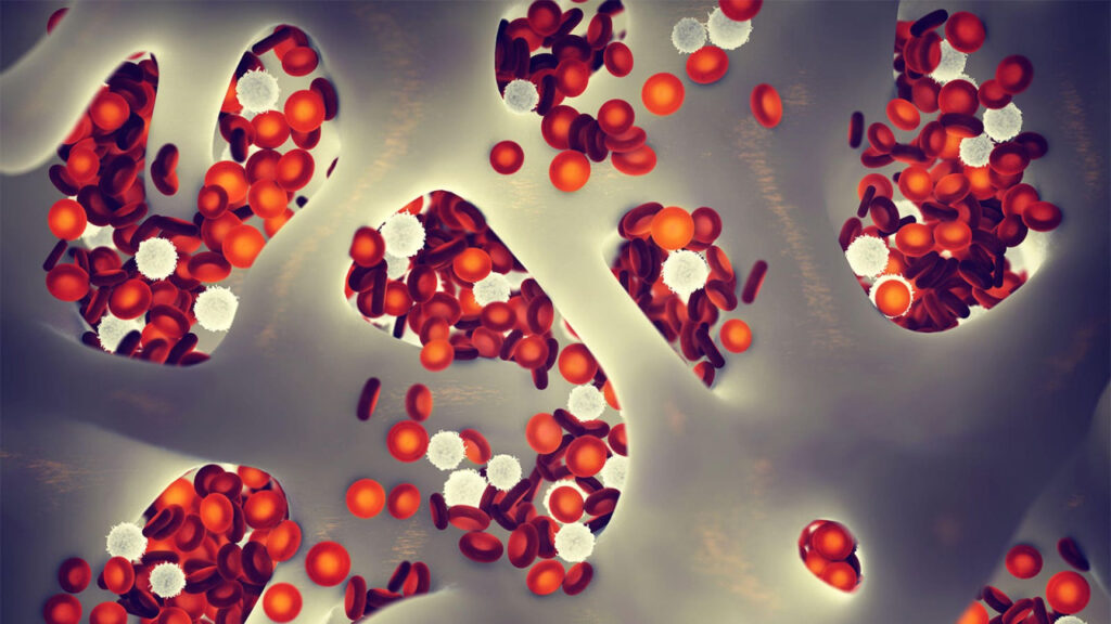 Asymptomatic or Minimally Symptomatic Myelofibrosis
