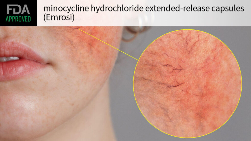 FDA Approves Glossy Option for Rosacea